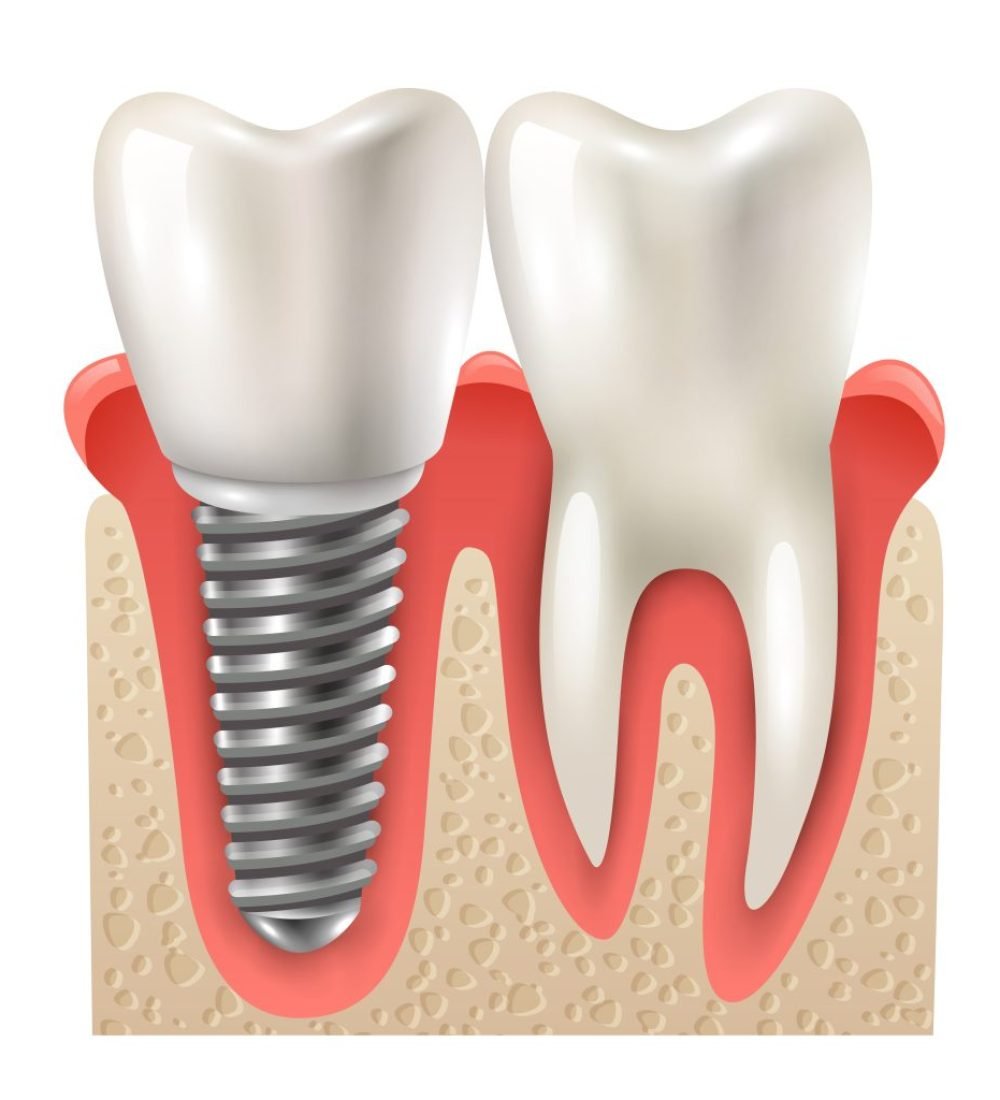 1-Gunde-Implant-1024x1024